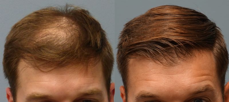 Hair Transplant